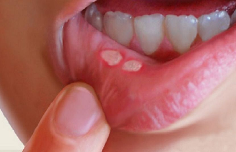 اگر تو منہ میں چھوٹے سفید نشان گلابی سطح پر ابھر آیا ہے تو یہ منہ میں چھالے یا زخم کی نشانی ہے۔