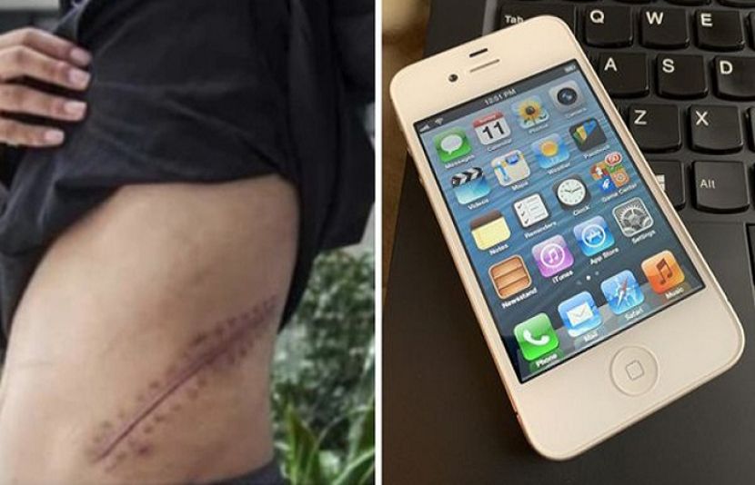 آئی فون خریدنے کے لیے گردہ بیچنے والا نوجوان اب دائمی بیماری میں مبتلا ہے