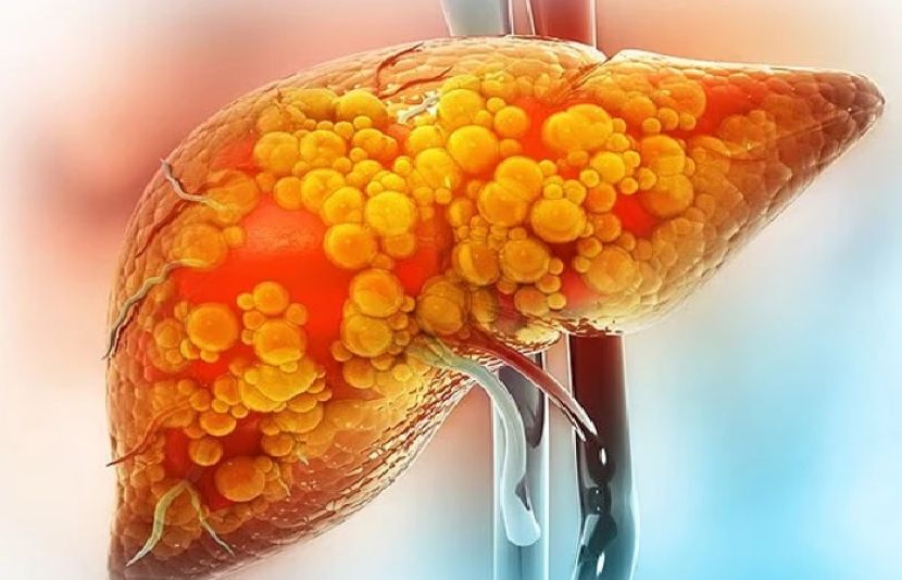 مصنوعی مٹھاس جگر کی مہلک بیماری کے خطرات میں اضافہ کر سکتا ہے