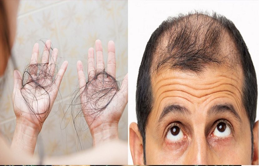 بالوں کو گرنے