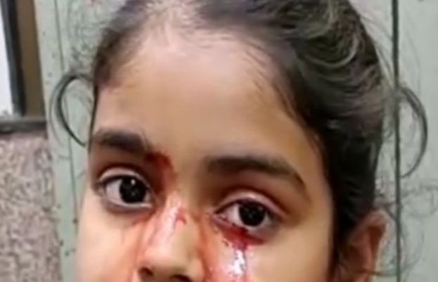 نئی دہلی کی رہائشی  گیارہ سالہ بچی کی آنکھوں سے خون کے آنسو نکلتے ہیں