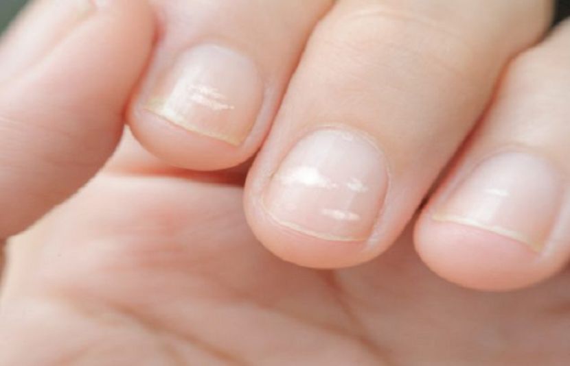 کیا ناخنوں پر موجود سفید نشانات خطرناک ہیں؟ نئی تحقیق سامنے آگئی