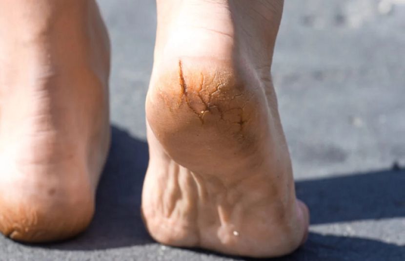 ایڑھیوں کا پھٹنا