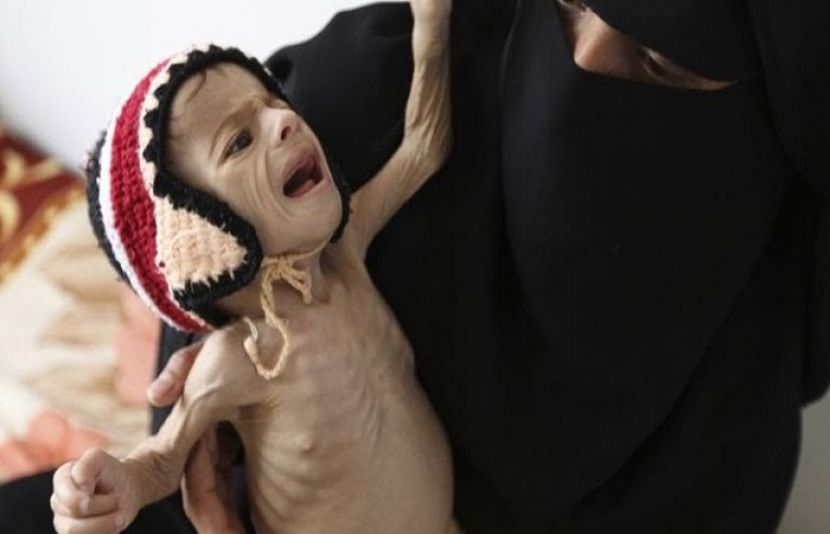 یمن جنگ: بھوک اور بیماری سے اس سال 50ہزار بچے جاں بحق