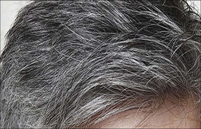 کم عمری میں سفیدبال کیوں؟