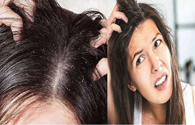 سر کی خُشکی ختم کرنا اب نہایت آسان ہو گیا
