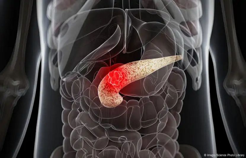 لبلبے کا کینسر