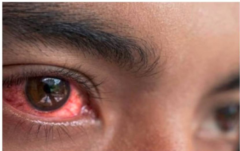 پاکستان میں آشوب چشم کی وبا کی وجہ دریافت کر لی گئی