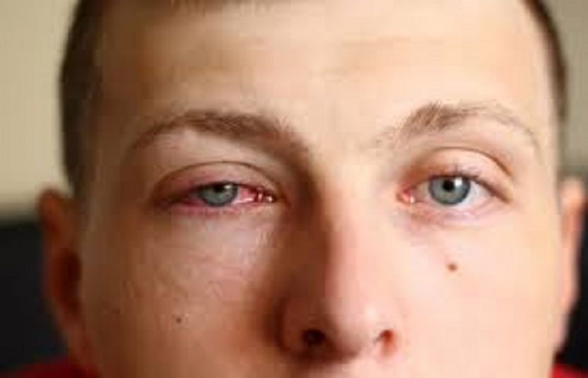 آنکھوں کی الرجی بھی آنکھوں کی سوزش کا اہم سبب ہے۔