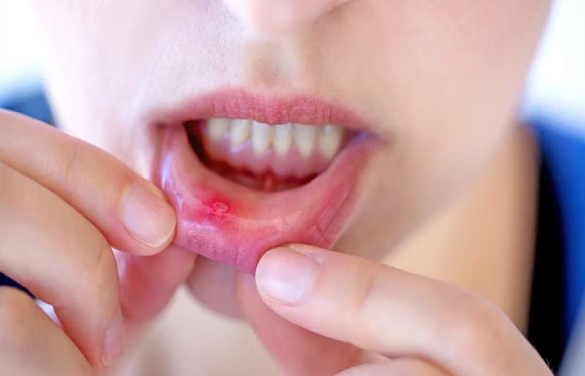  منہ میں چھوٹے سفید نشان گلابی سطح پر ابھر آیا ہے تو یہ منہ میں چھالے یا زخم کی نشانی ہے۔