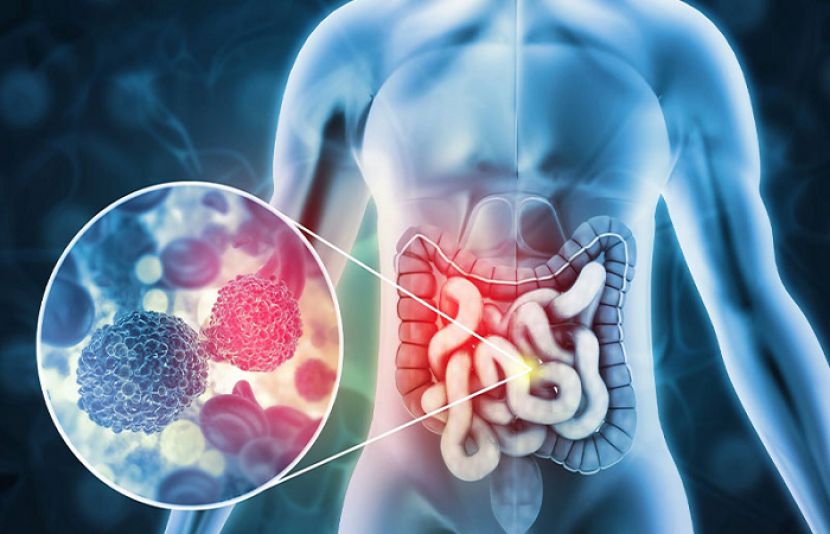 آنتوں کے کینسر کی شرح میں اضافہ